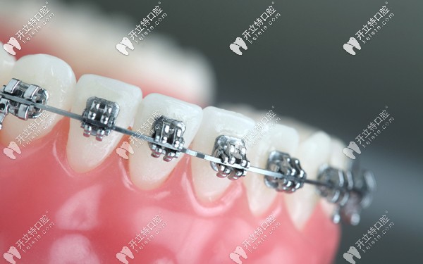 在大同做牙齒矯正的費(fèi)用整體不算貴