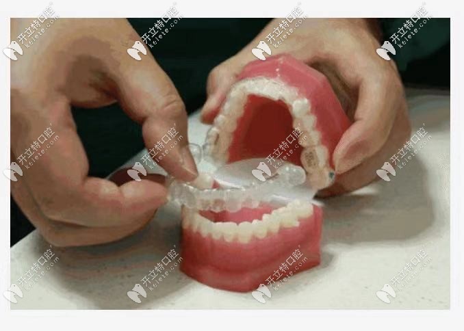 透明牙套受年輕人青睞隱形美觀