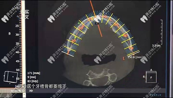 可以看出牙槽骨已經(jīng)萎縮了