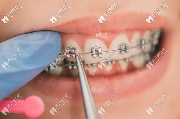 廣州天河區(qū)牙齒矯正
