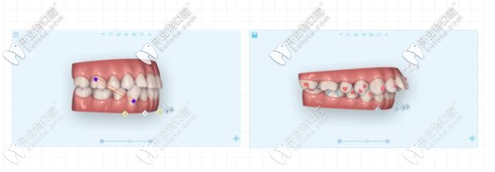 牙齒錯(cuò)頜畸形矯正