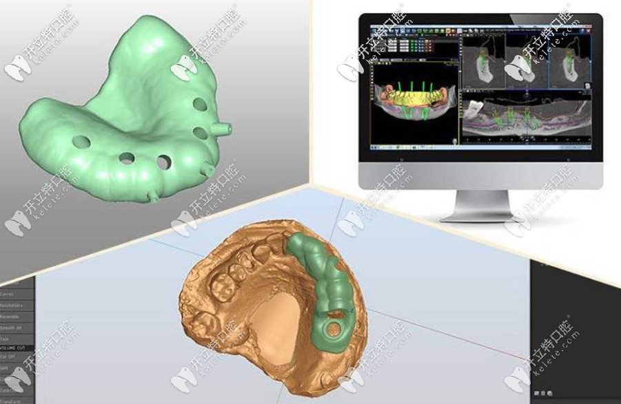 導板種植牙與普通種植牙的區(qū)別在哪