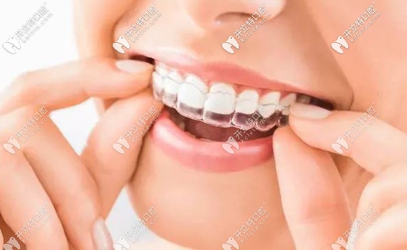 聽說國外建議戴著隱形牙套吃東西,那不會磨損矯正器嗎？