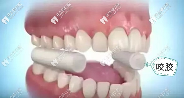 隱形牙套咬膠