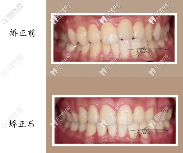 牙齒矯正前后照片