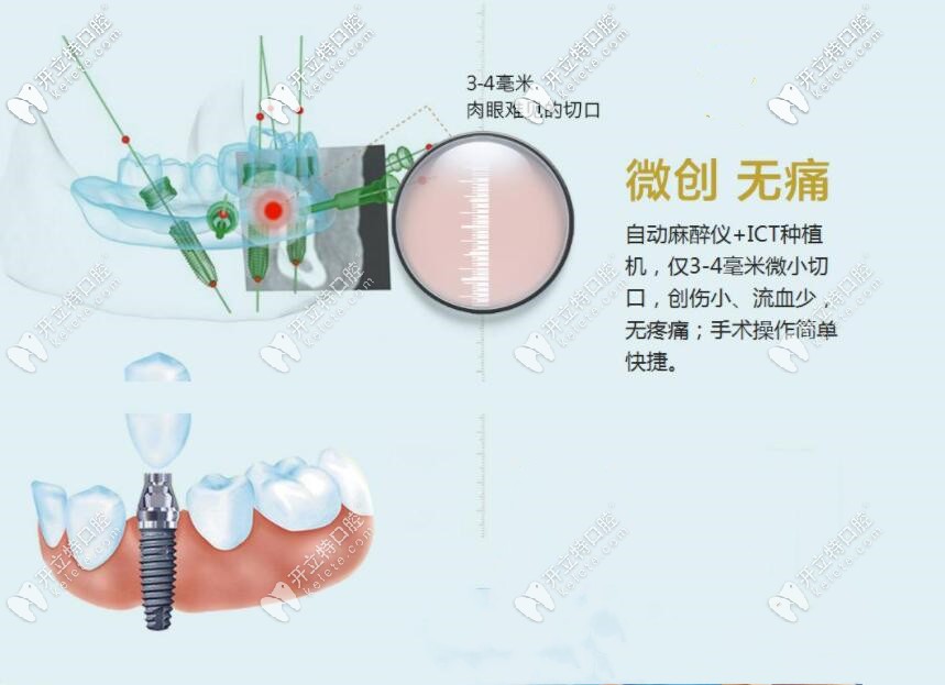 微創(chuàng)種植牙優(yōu)勢(shì)