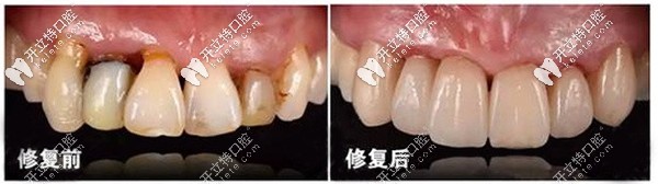 氧化鋯全瓷牙修復(fù)案例