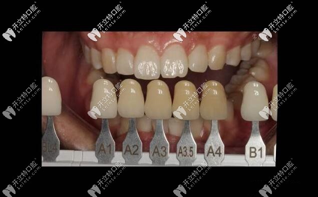 牙齒比色