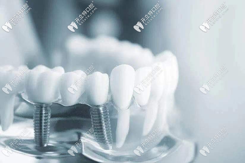 種植牙的費(fèi)用情況