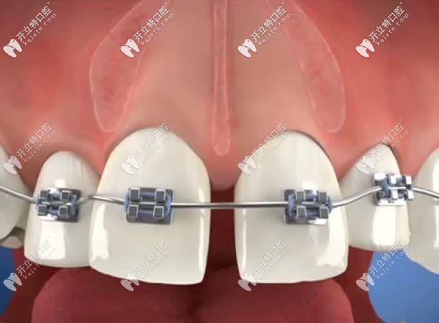 牙齒矯正修復牙縫