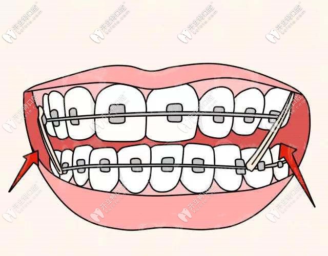 托槽矯正器的價(jià)格展示