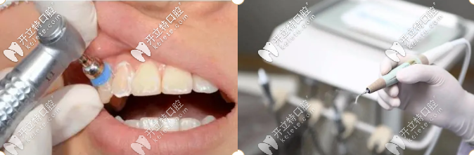 潔牙、牙修復(fù)等立減價(jià)格