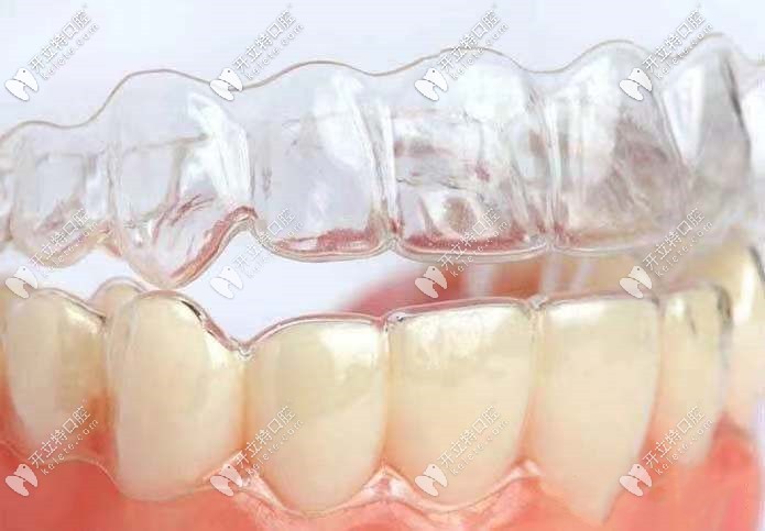 隱形矯正器的價(jià)格