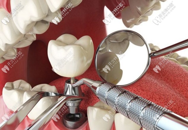 種植牙種植過程示意圖 種植牙種植過程示意圖