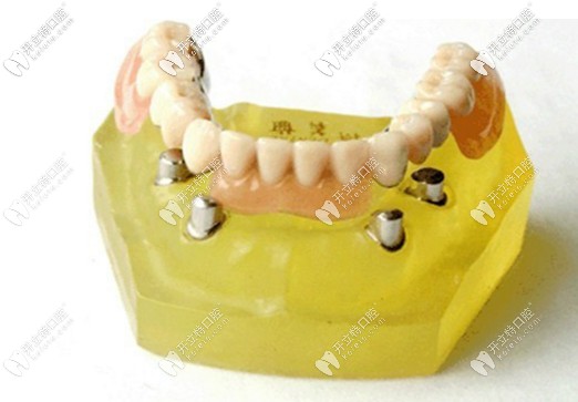 套筒式精密附著體 套筒式精密附著體