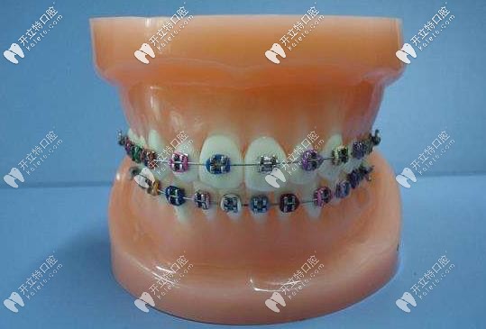 直絲弓矯正器外觀