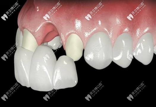 全瓷牙修復(fù)門牙缺失示意圖 全瓷牙修復(fù)門牙缺失示意圖