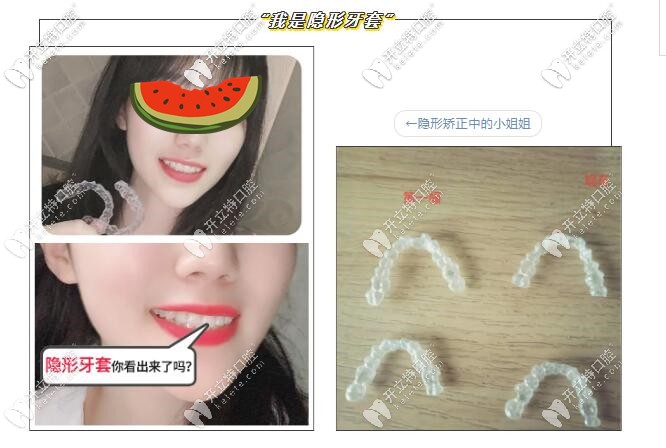 隱形牙套圖示