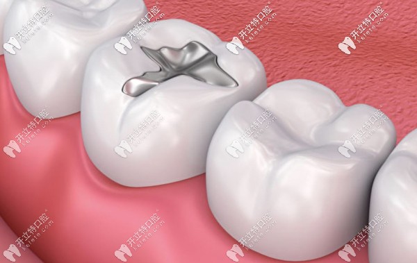 陽泉市的補(bǔ)牙參考價(jià)格