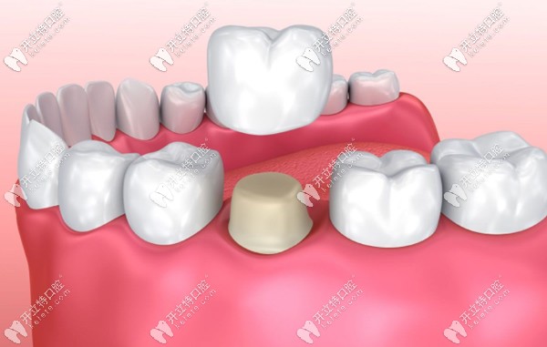 陽泉全烤瓷牙的參考價(jià)格
