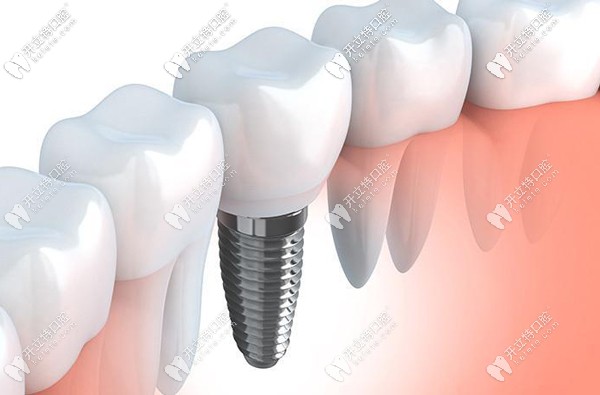 陽泉市種植牙參考價(jià)格