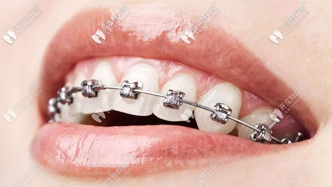 初戴牙套會感覺到疼痛