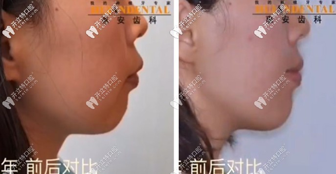 看呆！凸嘴少女在惠安齒科戴自鎖托槽矯正半年后…