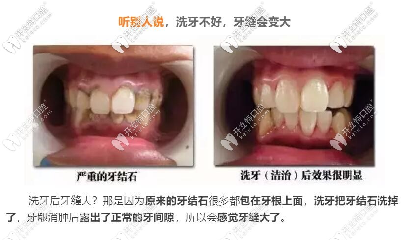 洗牙牙縫會(huì)變大嗎