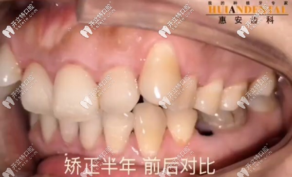 側(cè)面牙齒的情況