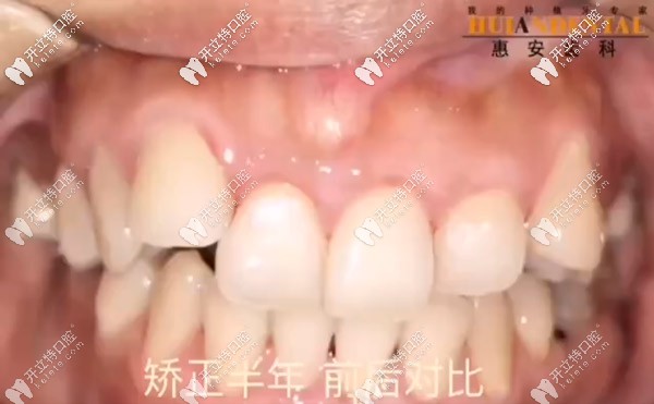 矯正前牙齒的正面照