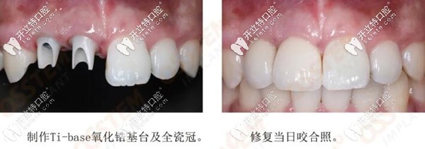 種植后戴臨時牙冠的照片