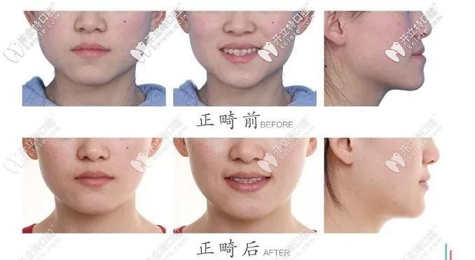 牙齒正畸前后對(duì)比圖