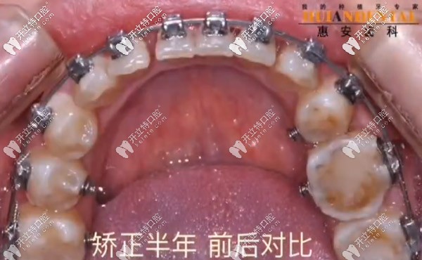 矯正后經(jīng)過治療沒有了蛀牙