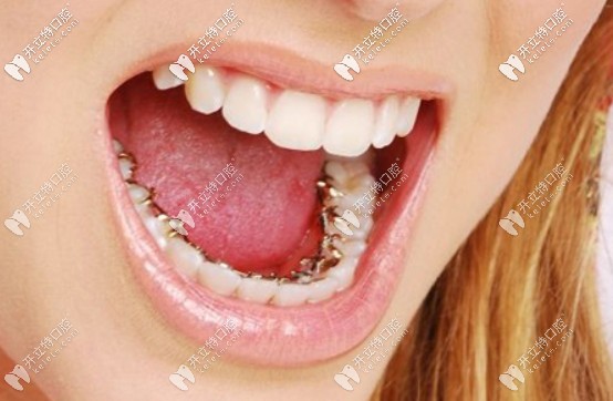 舌側(cè)矯正費(fèi)用