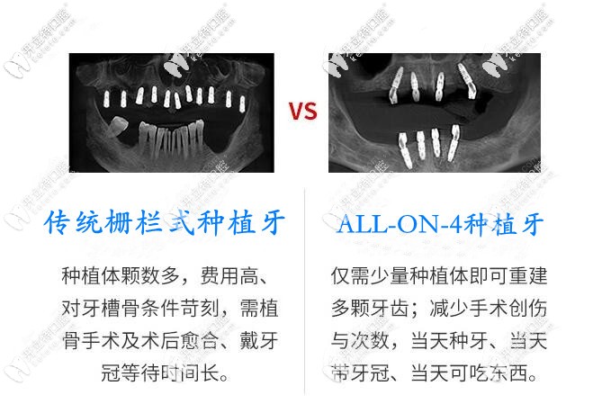 長(zhǎng)沙德韓ALL-on-4種植VS傳統(tǒng)種植牙