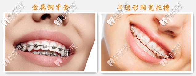 固定牙齒矯正器的分類(lèi)
