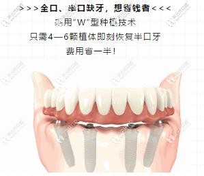 長(zhǎng)沙德韓牙科做ALL-on-4種植牙