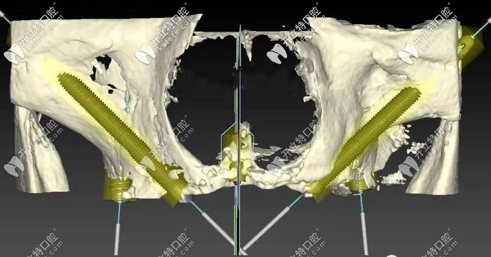 穿顴穿翼種植 穿顴穿翼種植