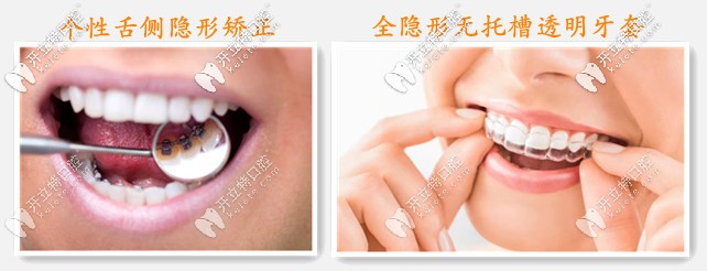 全隱形牙齒矯正器的分類(lèi)