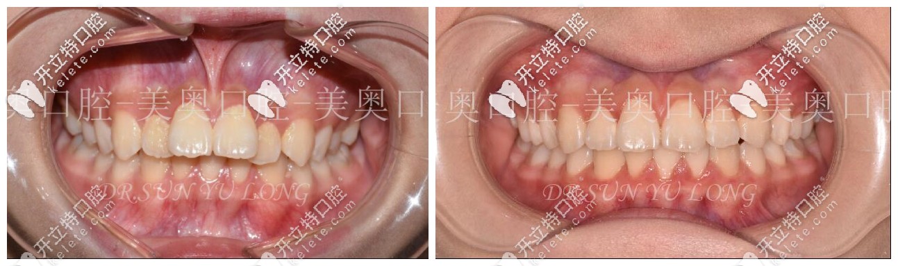齙牙矯正前后對(duì)比圖