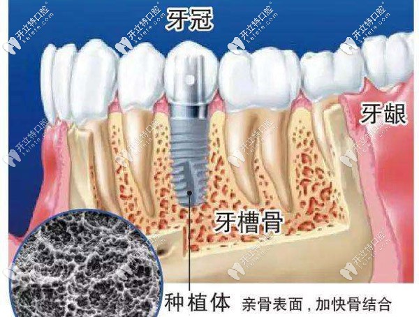 種植牙的組成部分