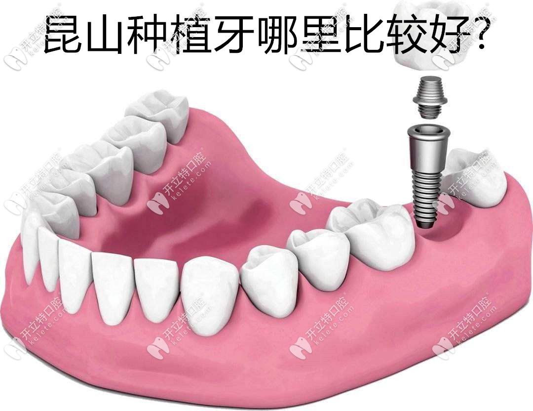 昆山種植牙哪里比較好?有木有種牙醫(yī)院排名和價(jià)格表可撩
