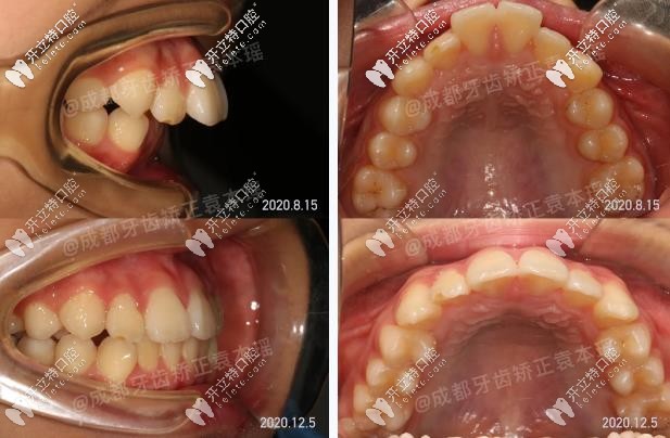 小朋友齙牙的前后矯正對(duì)比