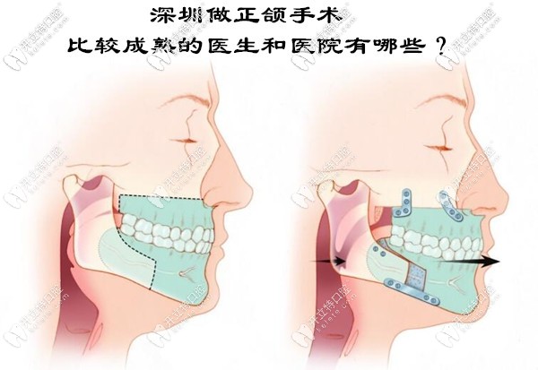 深圳正頜手術比較成熟的醫(yī)生和醫(yī)院有哪些