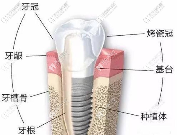 進(jìn)口種植體的組成部分