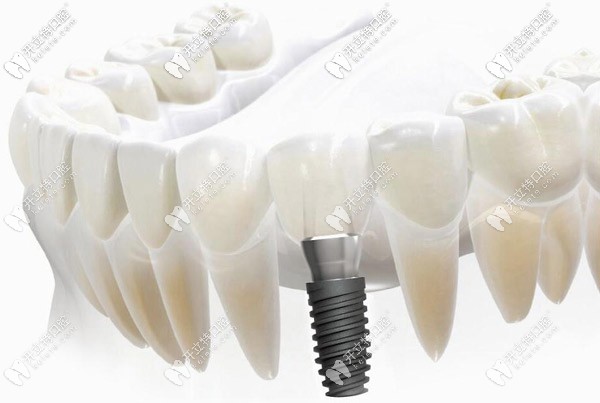 幾千塊的種植牙到底靠譜嗎