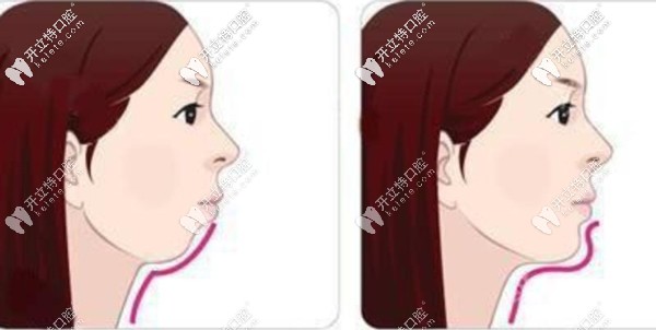 A6隱形牙套可以打開咬合前導(dǎo)下頜