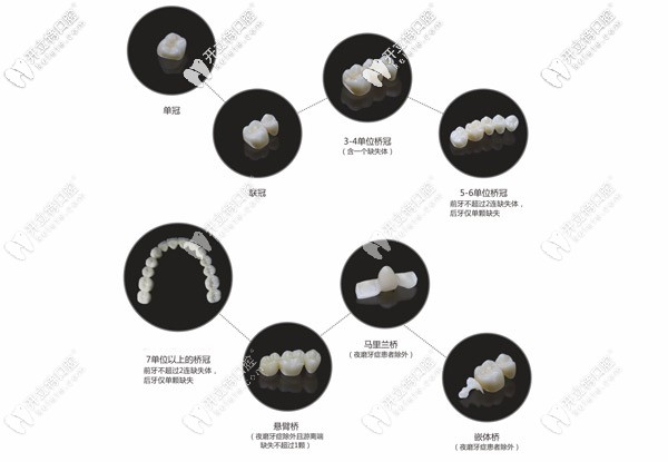 牙冠的種類及價格