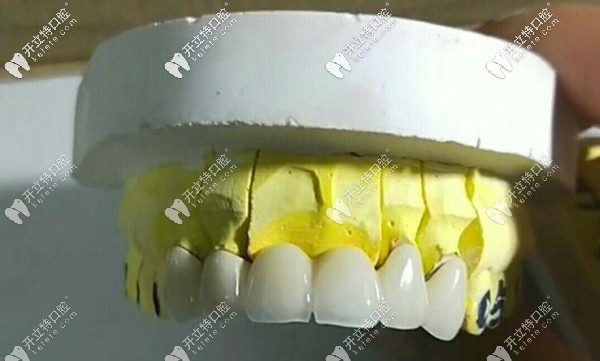 普通的二氧化鋯全瓷牙示意圖