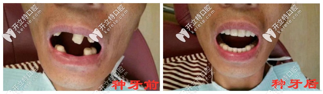 種牙前后對比